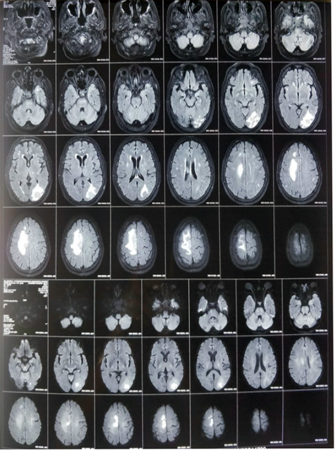 MRI brain-Lesions in right parafalcine region, right occipital region showing peri-lesional edema and diffusion restriction on DWI