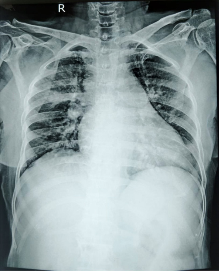 X-ray chest- Consolidation in right middle lobe of lung with lymphadenopathy