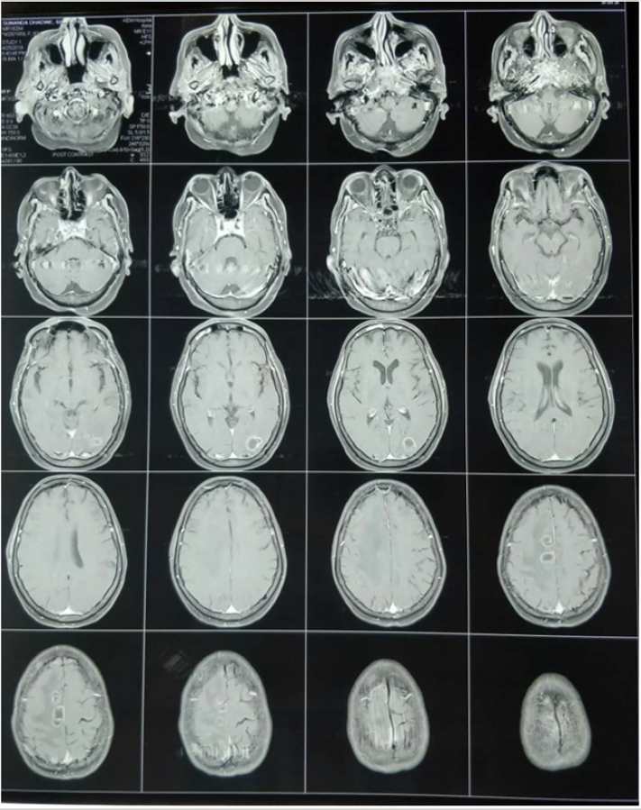 MRI Brain-Lesions in right parafalcine region, right occipital region showing peri-lesional edema and diffusion restriction on DWI