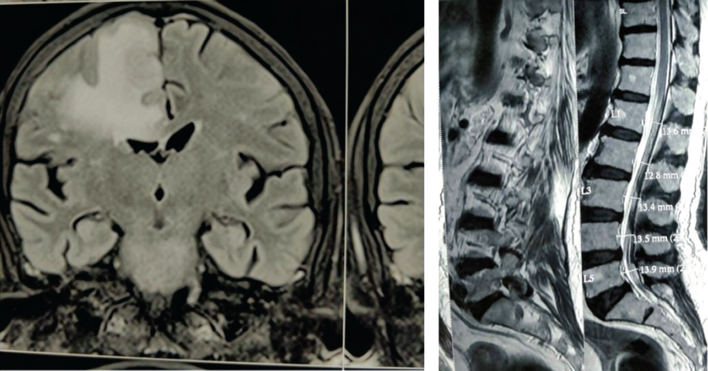 MRI Spine-T2 isointense lesion in prevertebral region at D12-L1level, degenerative changes in spine at L4-5 and L5-S1 level