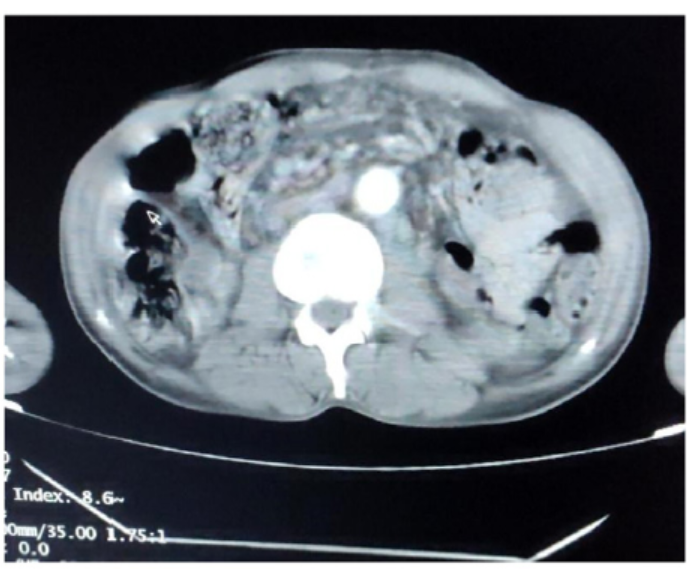 Computed Enhanced Contrast Tomography [CECT] revealed an asymmetric circumferential infiltrative growth of 9mm in the pyloric antrum