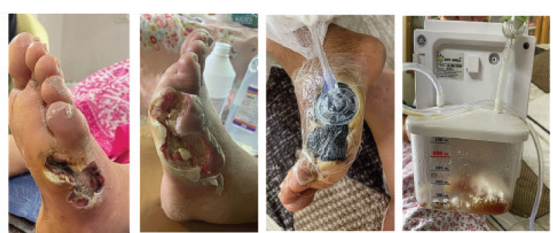 Chronic diabetic foot ulcer (DFU) on the plantar surface of the left foot before and after surgical debridement, negative pressure wound therapy (NPWT) was applied using a vacuum-assisted closure (VAC) system.