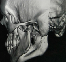 CT of face– 3D reconstruction showing fracture in the head of the mandible (right side).