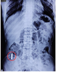 X-Ray showing the position of lodgement of bullet in the Ascending Colon.