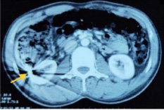 CT showing the Intra-abdominal position of lodgement of the bullet in the right lumbar region just posterior to the right kidney in the retroperitoneal space.